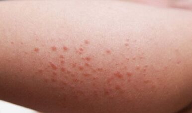 външни прояви на наличието на паразити в тялото